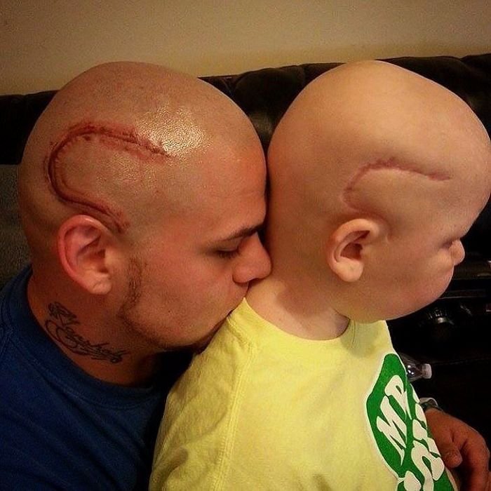 Что бы поддержать сына, отец сделал татуировку, напоминающую шрам сына