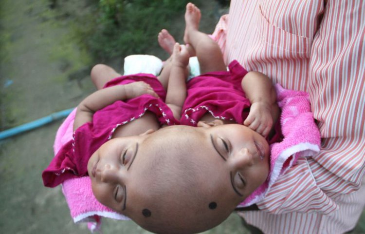 В Бангладеш родились близнецы с одной головой на двоих
